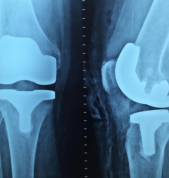 Röntgen Knie